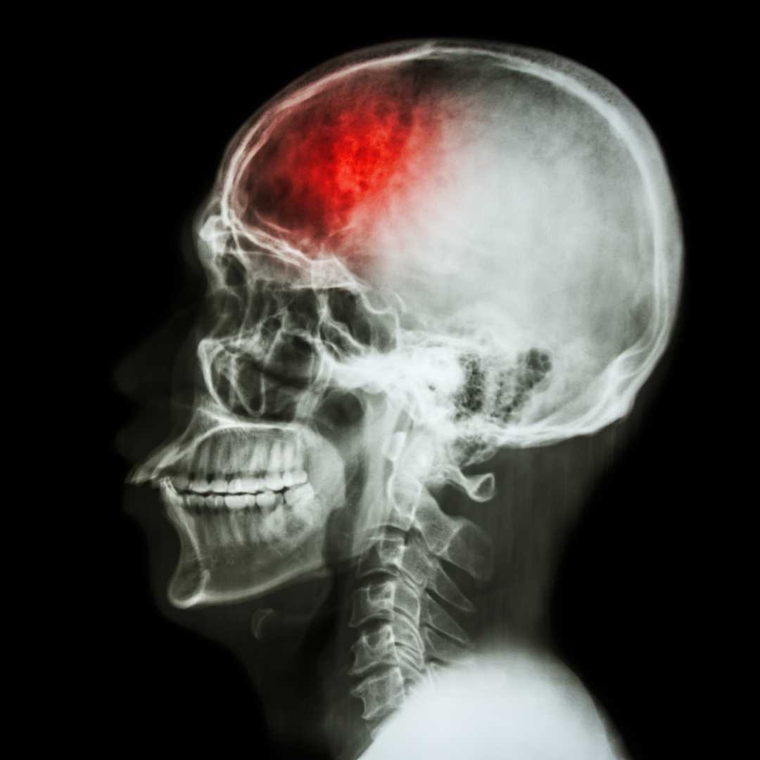 X-ray side view of a human skull showing a red-highlighted brain injury area.