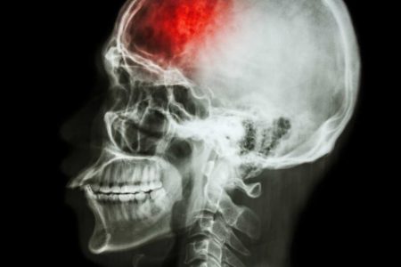 X-ray side view of a human skull showing a red-highlighted brain injury area.